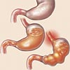 Reflux